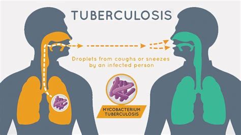 Tuberculosis: Causes and How It Spreads